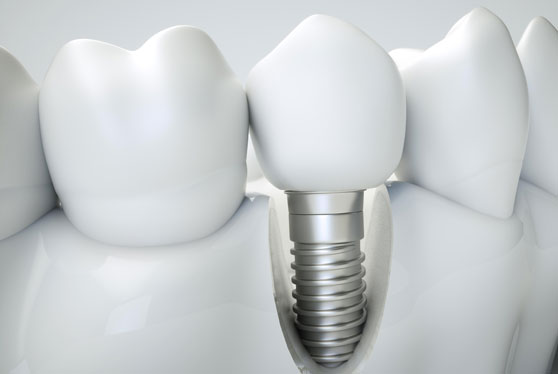 dental implant treatment