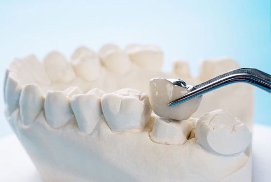dental crown melbourne
