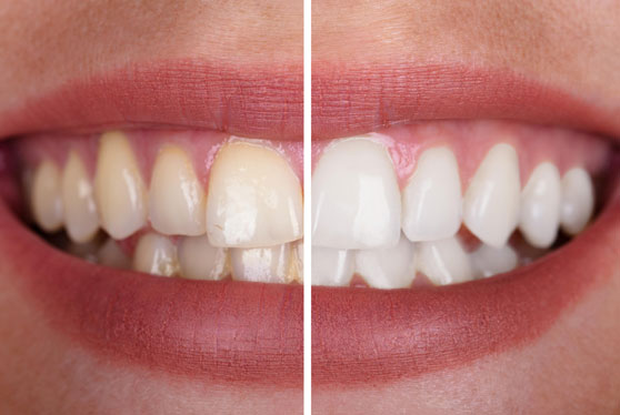 teeth whitening treatment - before after picture