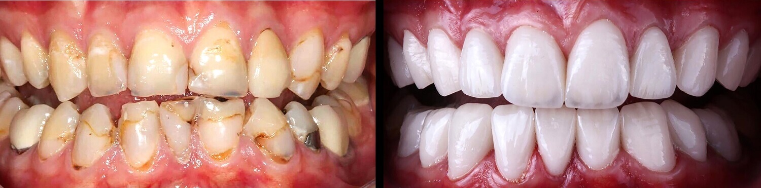 Rotten tooth & Clean Tooth Comparison