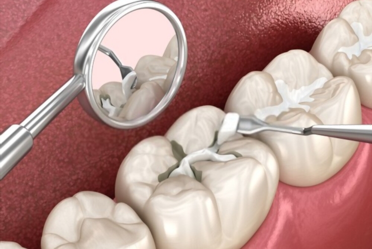 Dental Fillings Treatment