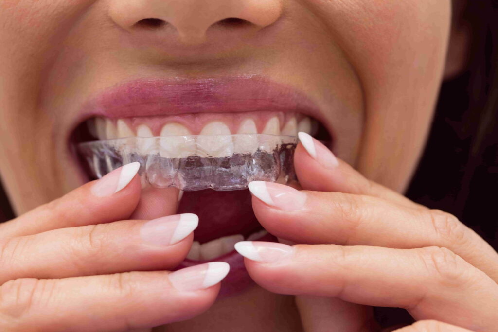 invisalign melbourne