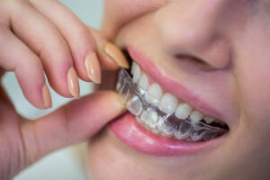 Invisalign Melbourne