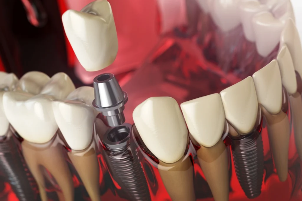 Dental Implant Surgery