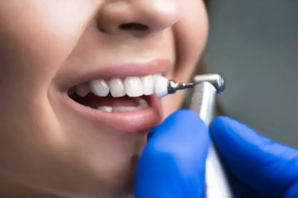 Professional Teeth Cleaning