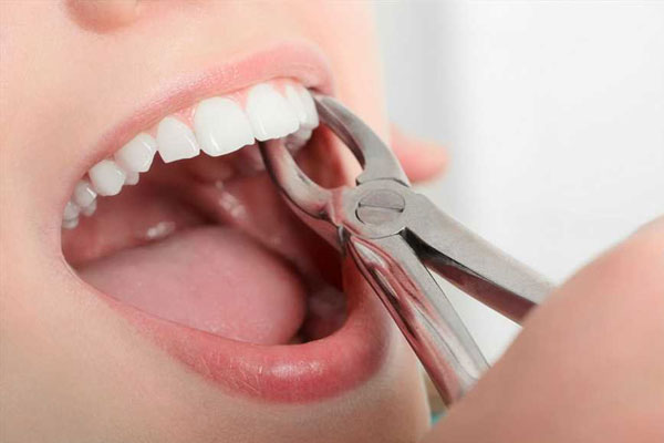 Wisdom tooth extraction swelling