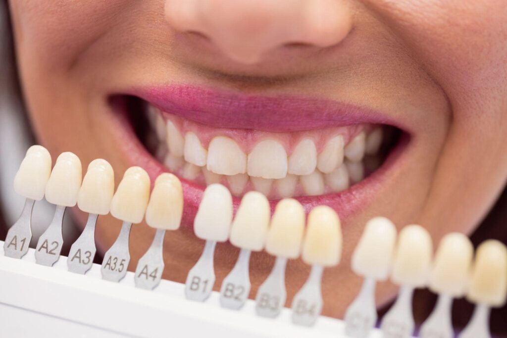 Veneers Melbourne